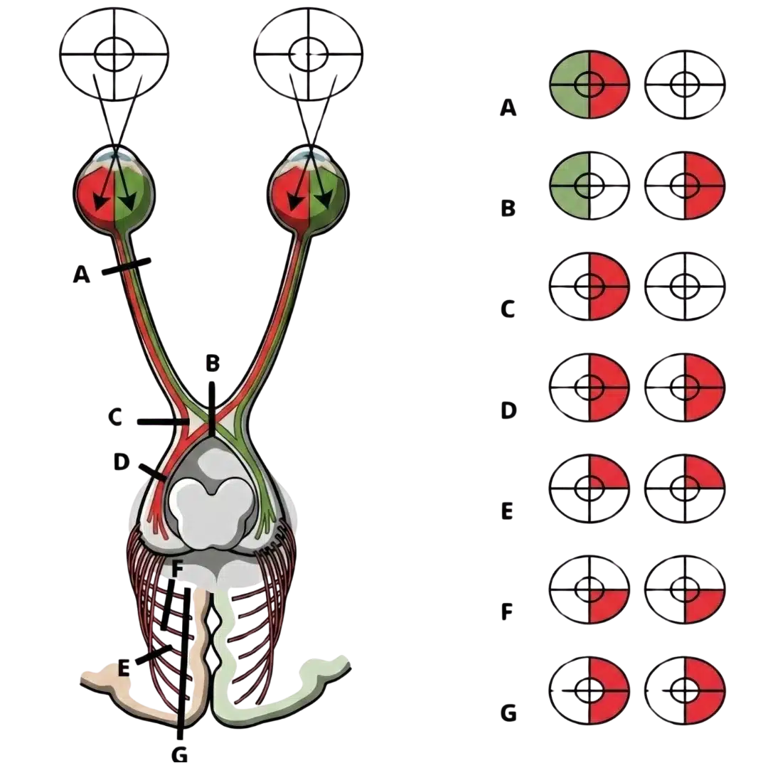 Schéma des déficits du champ visuel selon la localisation : cécité monoculaire en cas de lésion du nerf optique, hémianopsie bitemporale en cas de lésion du chiasma, hémianopsie homonyme controlatérale pour la bandelette optique, quadranopsies en cas d’atteinte des radiations optiques et hémianopsie homonyme avec macula épargnée en cas de lésion du cortex occipital